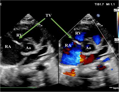 Diagnosis and intervention of severe tricuspid regurgitation secondary to rupture of the chordae tendineae: A case report and literature review